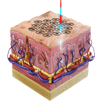 고해상도 레이저 리서페이싱