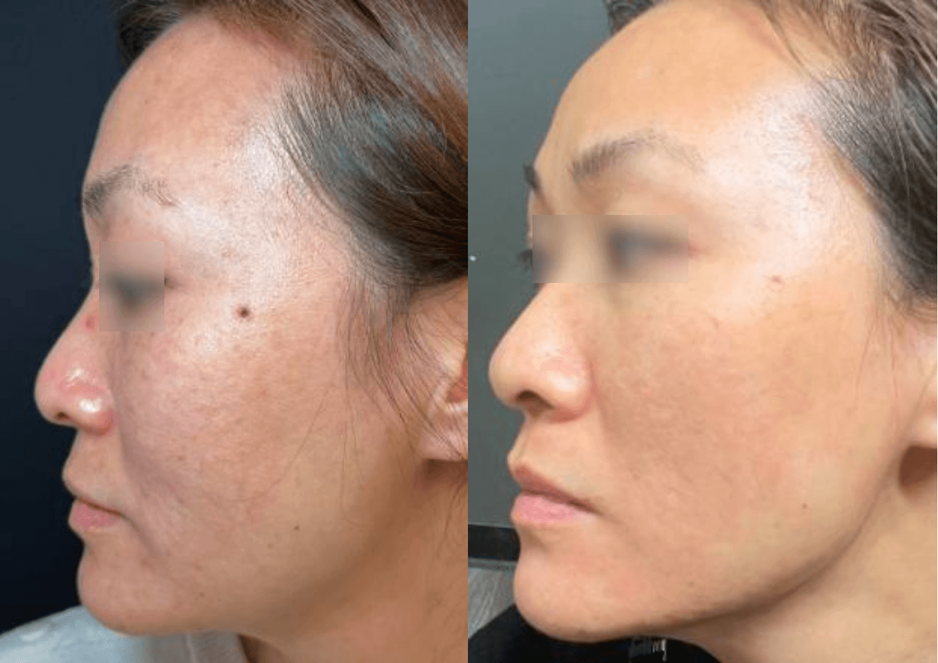 울트라클리어 전후 1