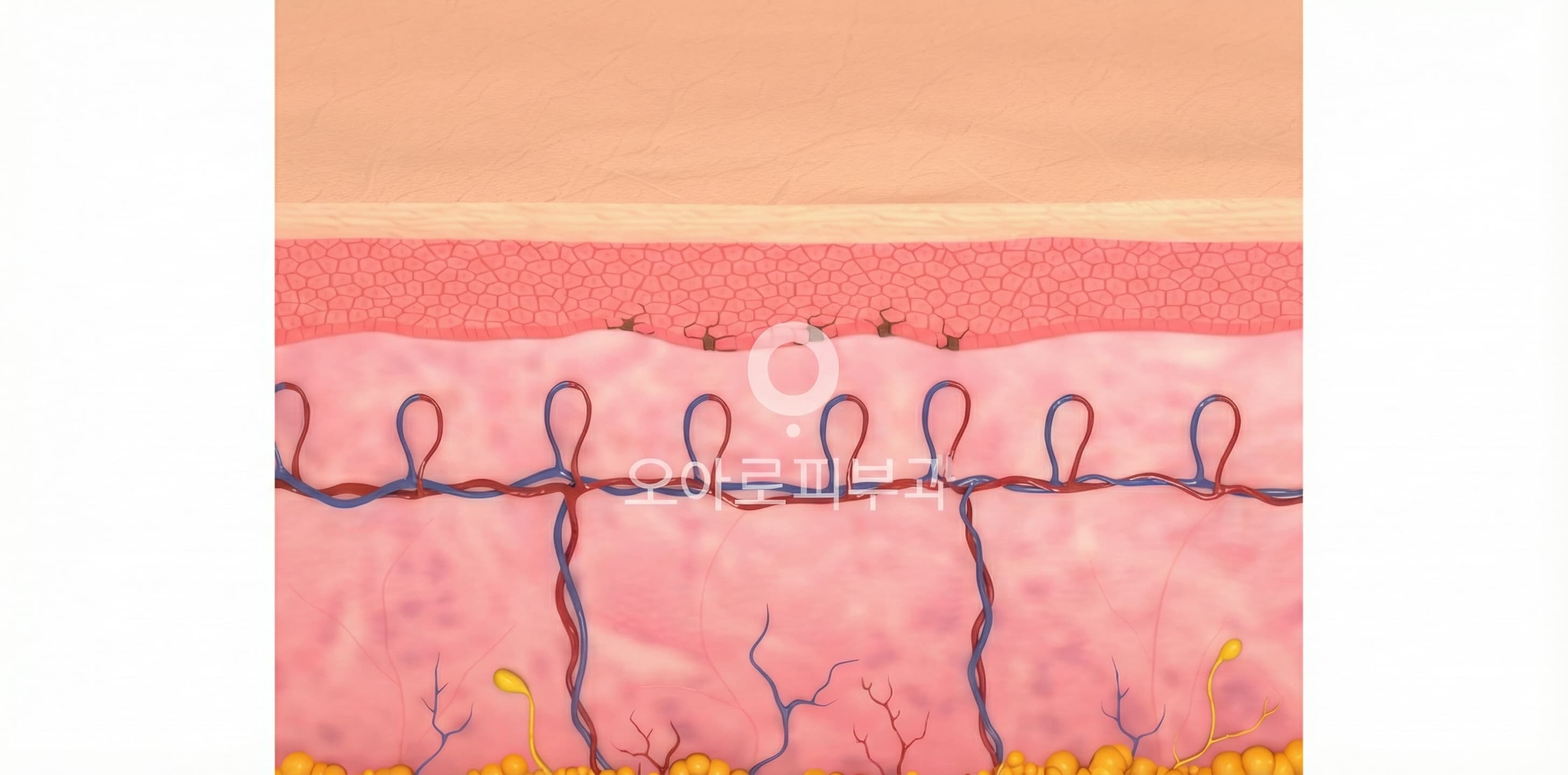 STEP 3. 색소 파괴 및 소멸