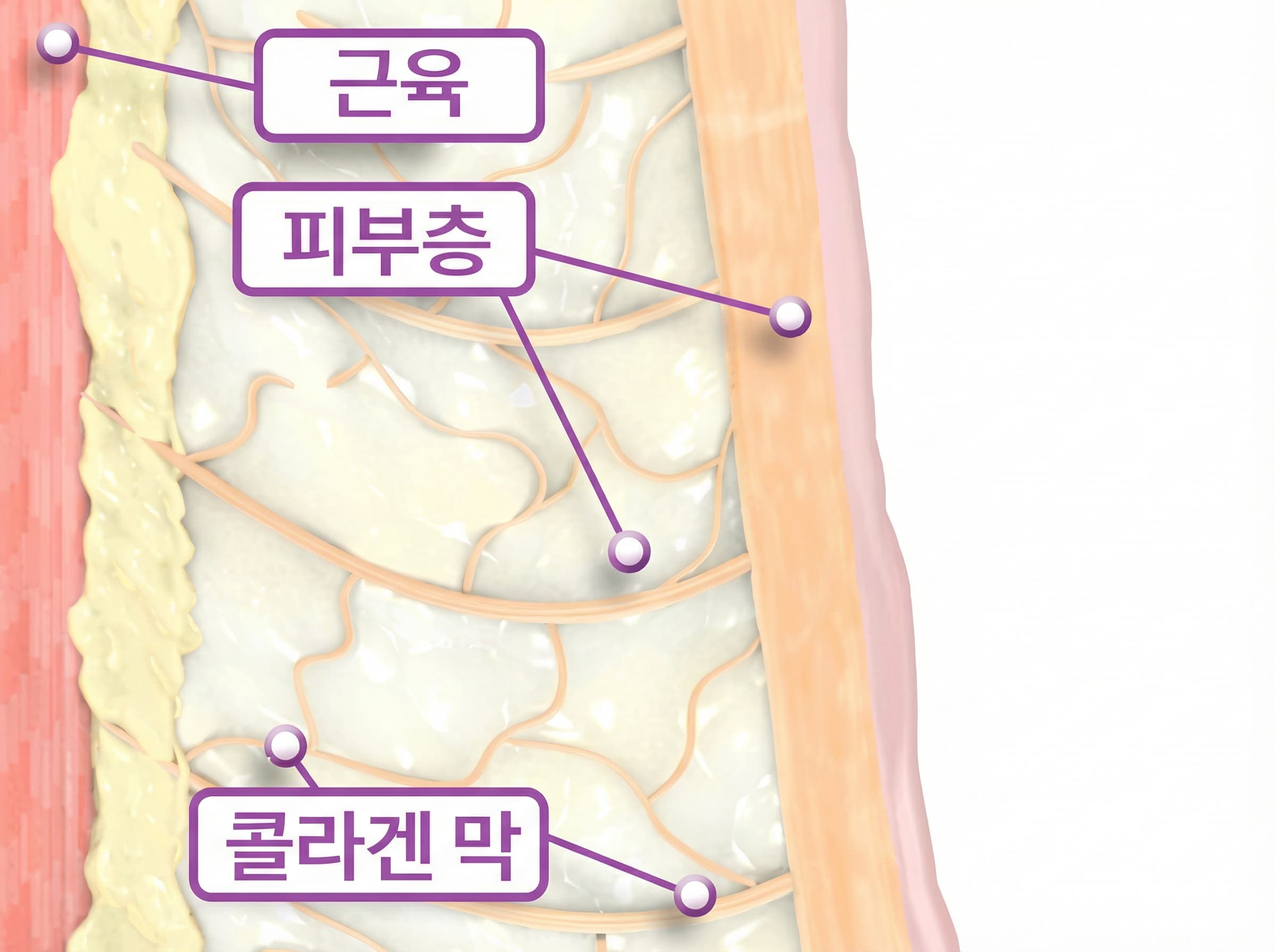 고주파 열 집중 기술