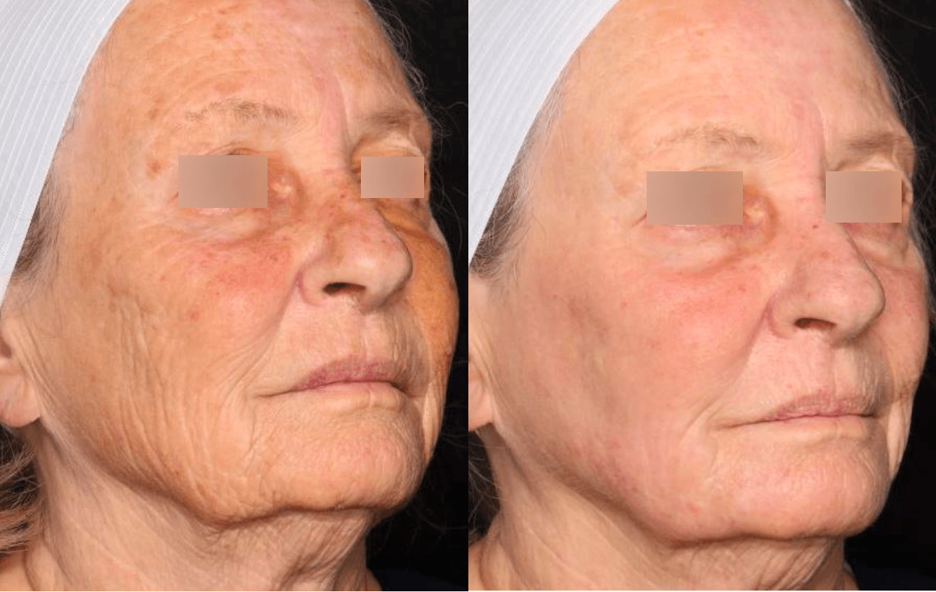 울트라클리어 전후 2