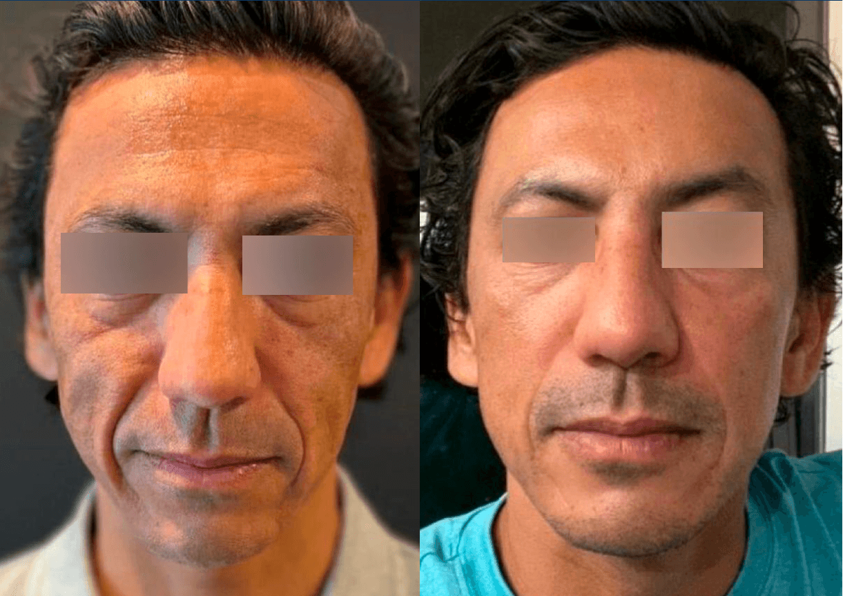 울트라클리어 전후 3