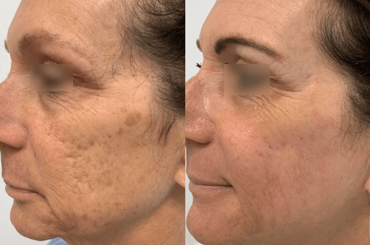 울트라클리어 전후 4